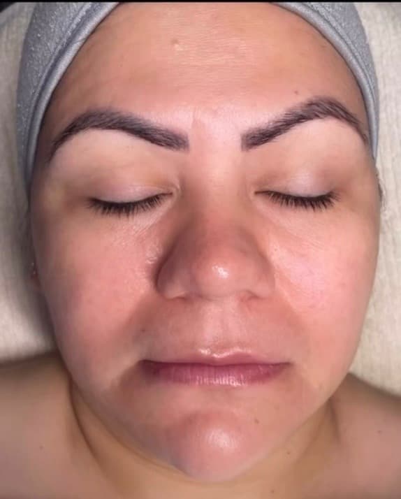 Antes - Lifting Facial HIFU