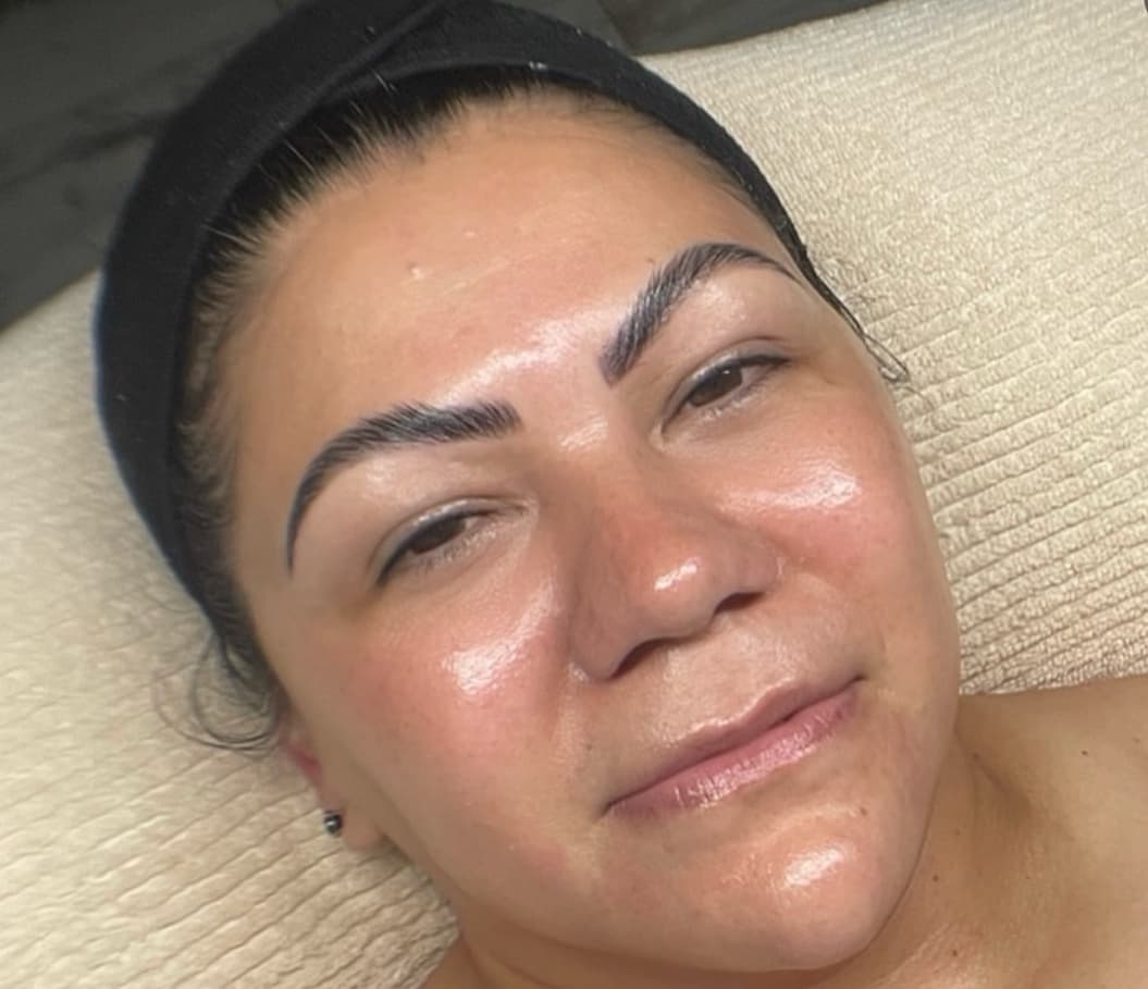 Después - Lifting Facial HIFU