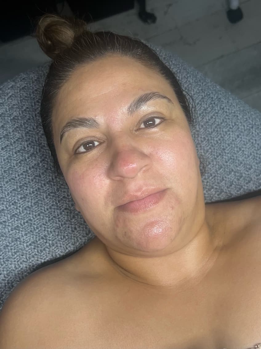 Después - Tratamiento Anti-Manchas