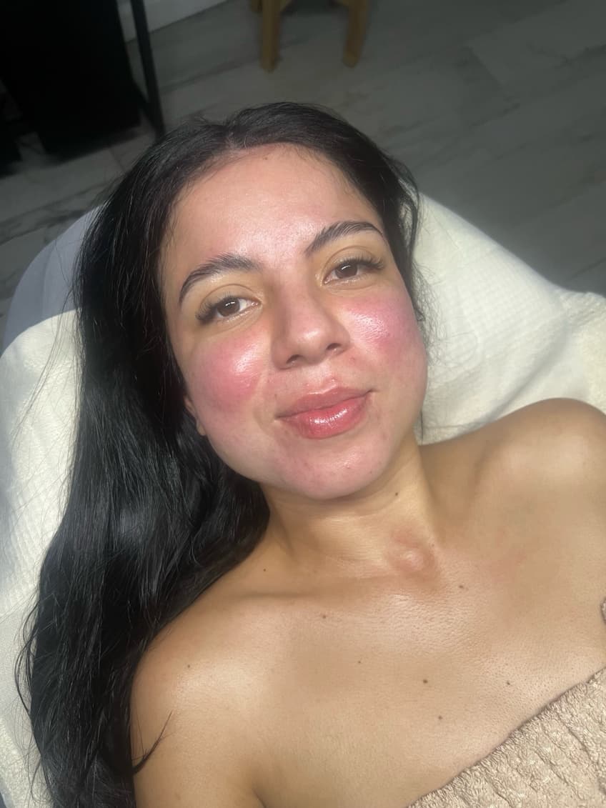 Después - Dermapen + Hidratación