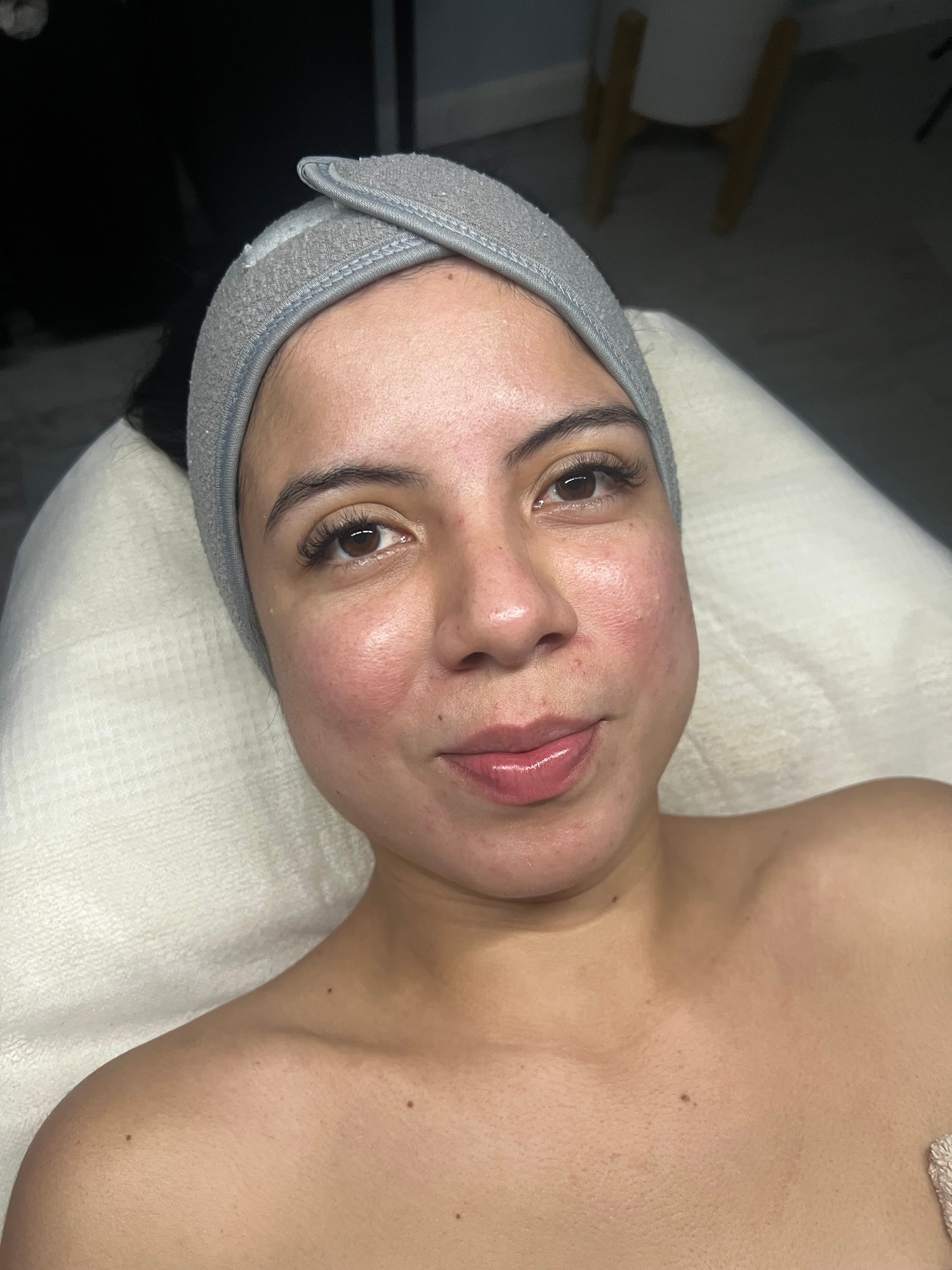 Antes - Dermapen + Hidratación