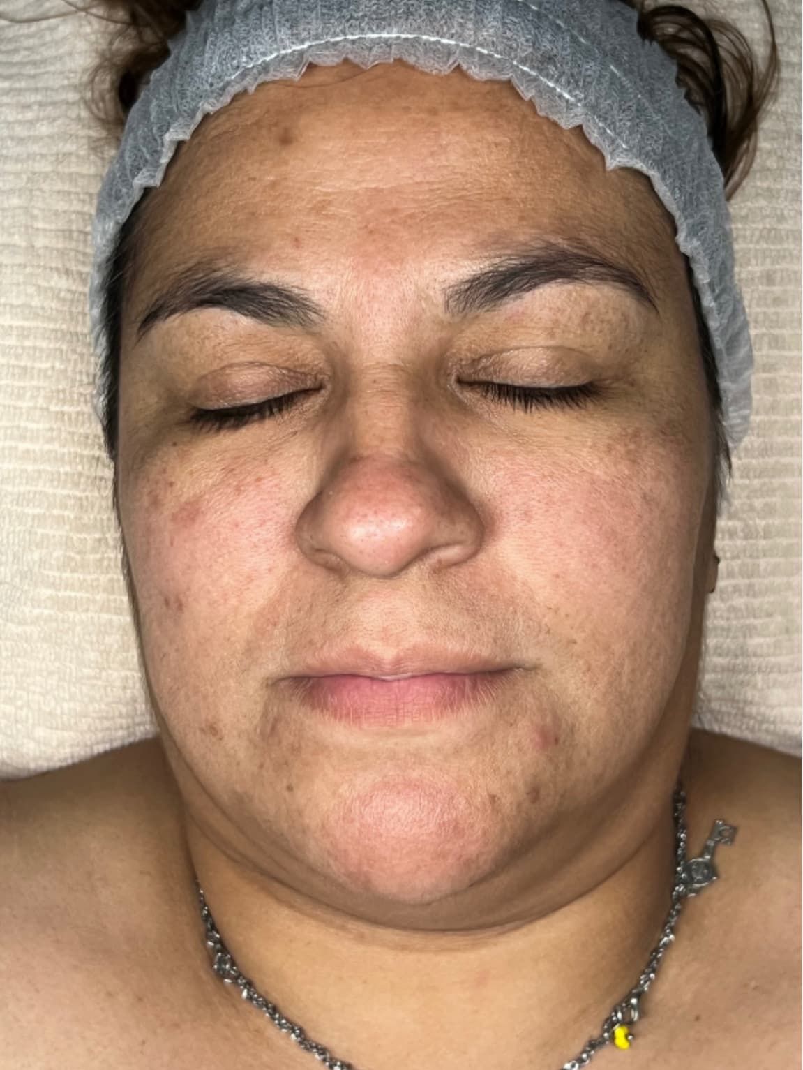 Antes - Tratamiento Anti-Manchas