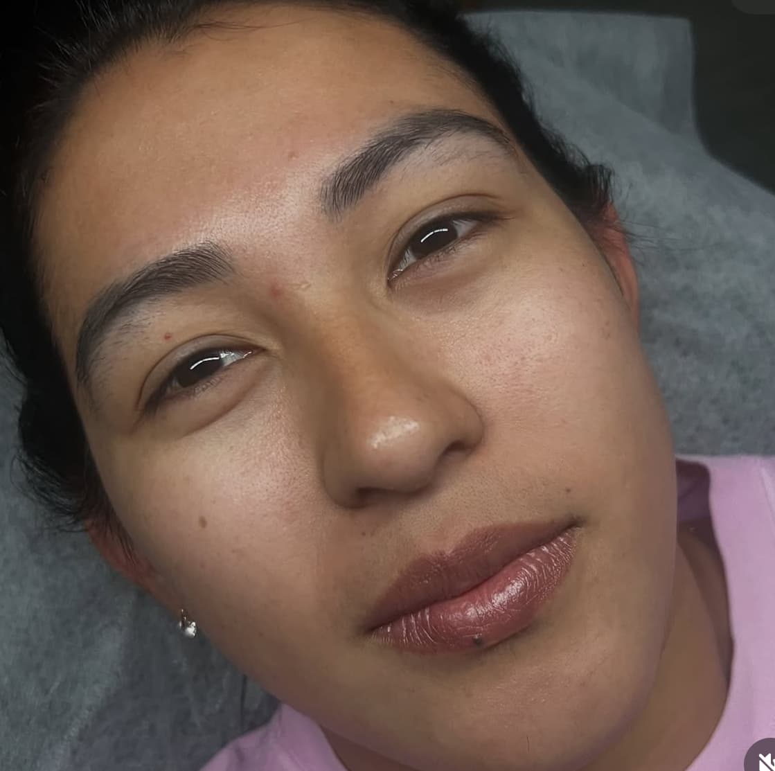 Antes - Peeling + Dermapen Combinado