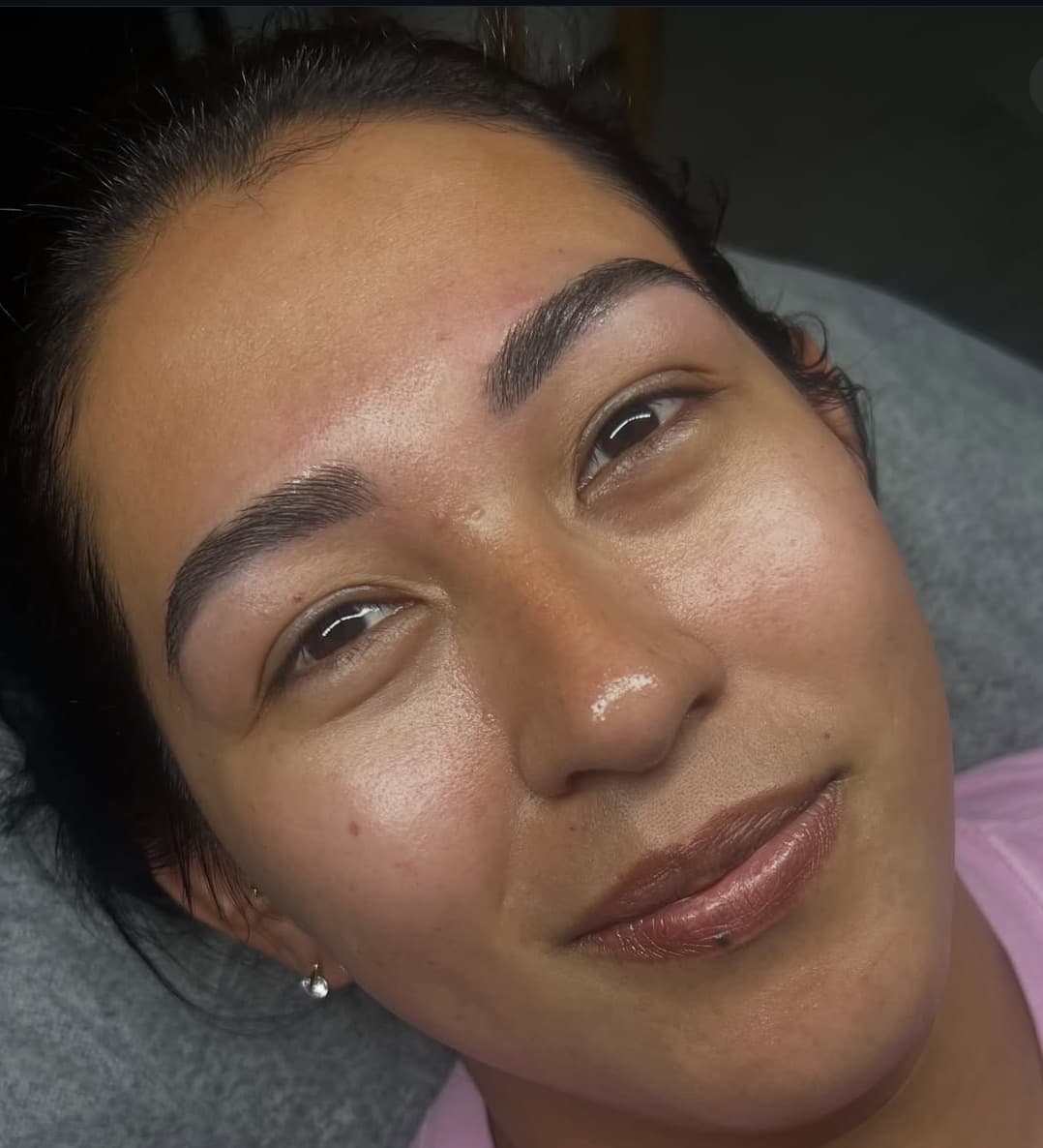 Después - Peeling + Dermapen Combinado