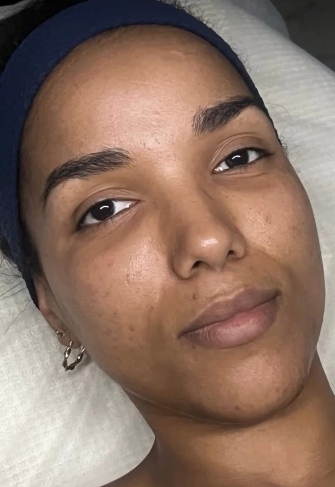 Antes - Peeling Facial + Tratamiento de Manchas