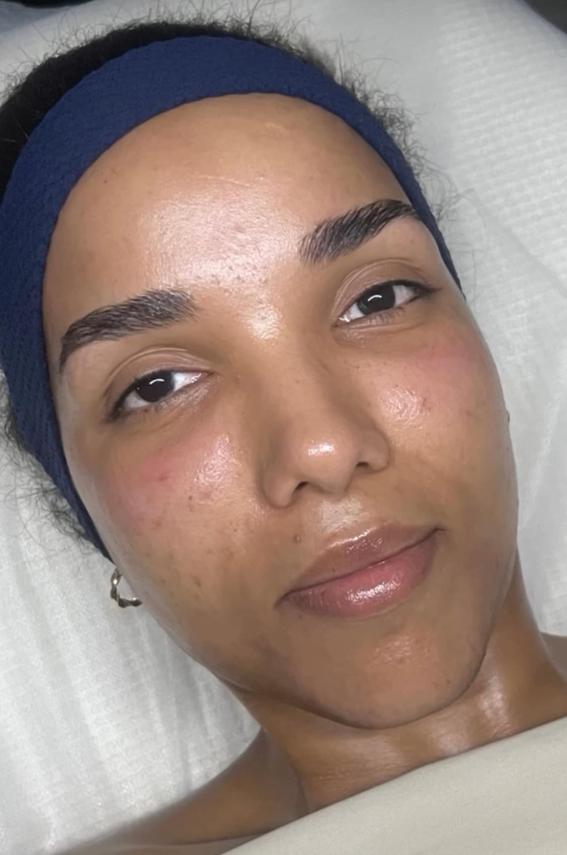 Después - Peeling Facial + Tratamiento de Manchas