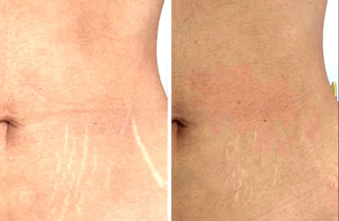 Resultado - Camuflaje de Estrías