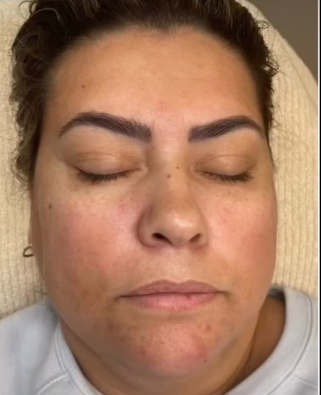 Antes - Lifting Facial - Hidratación