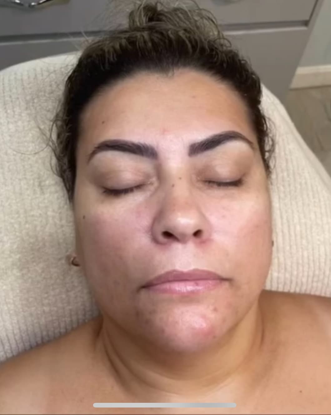 Después - Lifting Facial - Hidratación